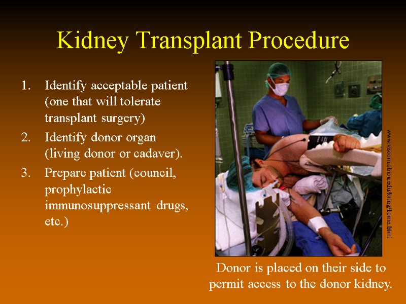 Kidney Transplant Procedure Identify acceptable patient (one that will tolerate transplant surgery) Identify donor